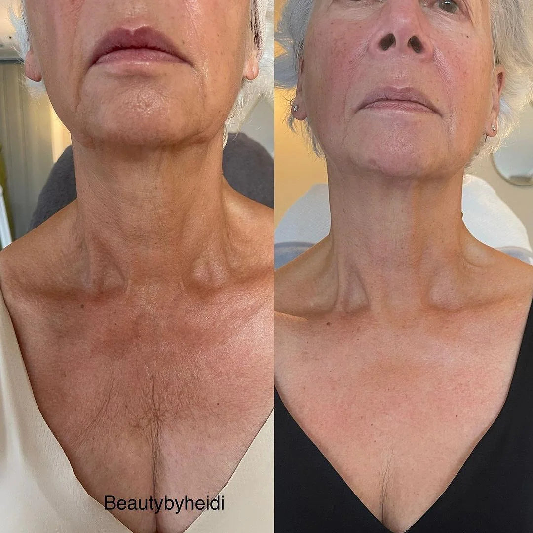 KrX Aesthetics | The Neck Lift Intensive Firming Cream
